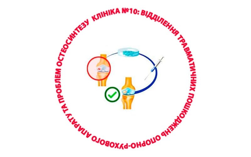 Аутологічний індукований матрицею хондрогенез (AMIC)