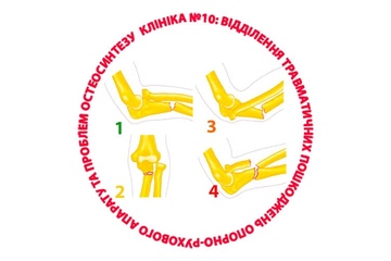 Что такое перелом Монтеджа?