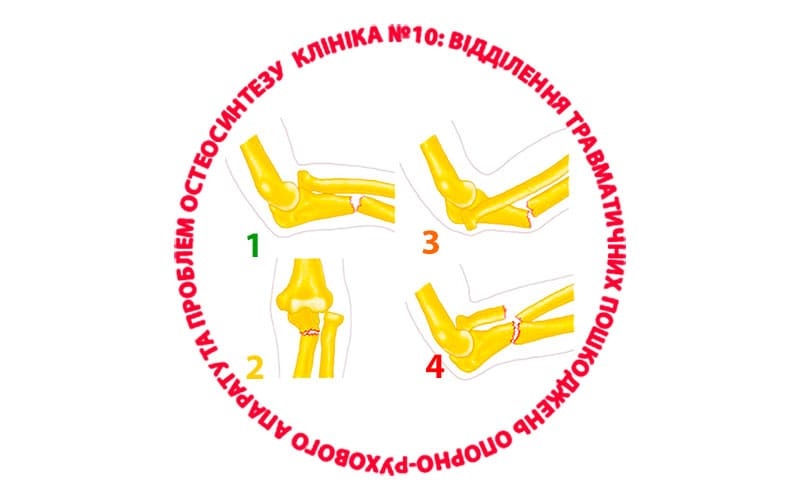 Что такое перелом Монтеджа?