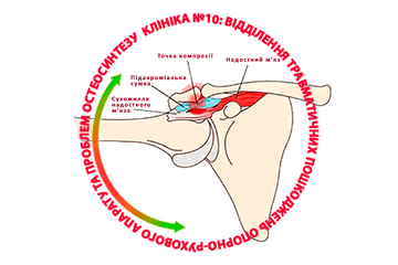Что такое импинджмент-синдром (субакромиальный синдром)?