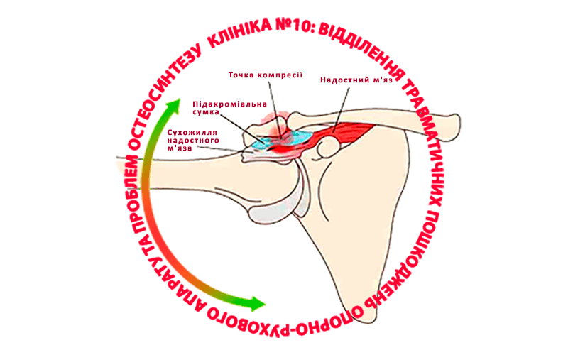Что такое импинджмент-синдром (субакромиальный синдром)?
