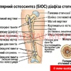 Интрамедуллярный металлоостеосинтез диафиза бедра (БИОС) в Киеве | Клиника № 10 ИТО НАМН Украины