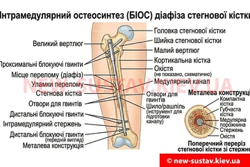 Что такое интрамедуллярный металлоостеосинтез диафиза бедра (БИОС)?