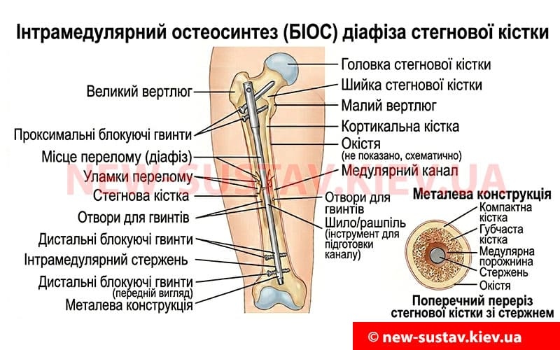 Что такое интрамедуллярный металлоостеосинтез диафиза бедра (БИОС)?