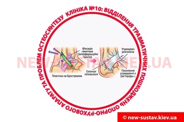Что такое операция реконструкции связок голеностопного сустава по Brostrom-Gould?