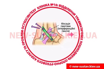 Что такое автопластика связок голеностопного сустава?
