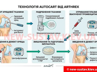 Операции по сохранению суставов технологией Autocart от Arthrex в Киеве | Клиника № 10 ИТО НАМН Украины