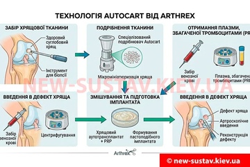 Как спасти сустав без протезирования - технология Autocart от Arthrex?